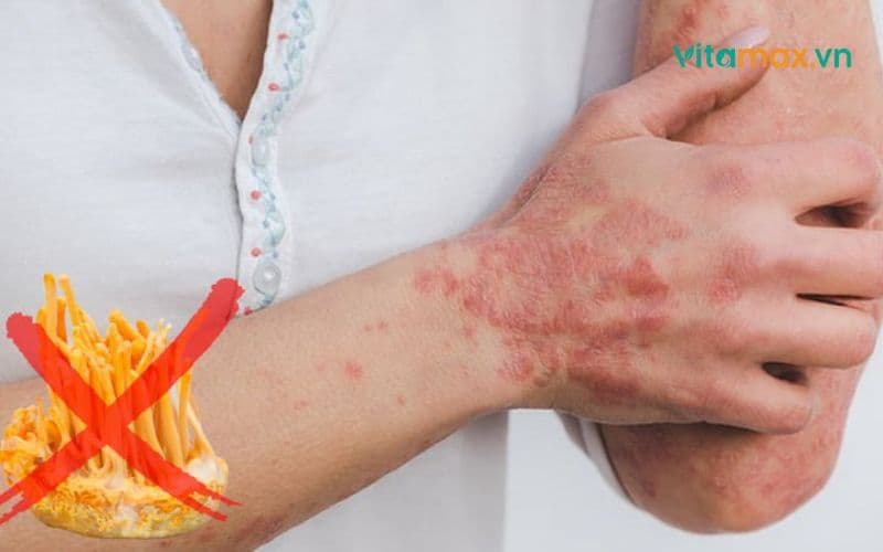 Dị ứng đông trùng hạ thảo: Sự thật về thảo dược quý này